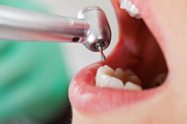 Best Emergency Wisdom Tooth Extraction in Bainbridge, PA